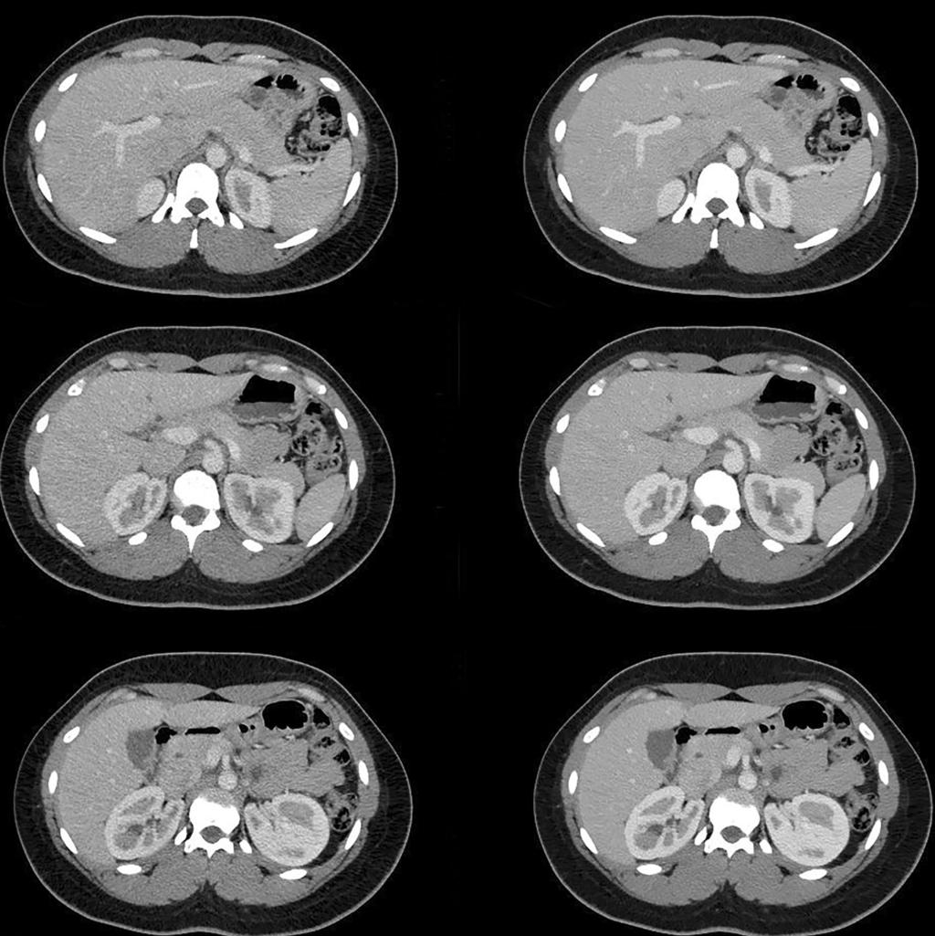 Fig. 3. Transverse abdominal CT images obtained in a 28-year-old woman. The noise is higher in polychromatic images (left) in comparison to virtual monoe images (right). The Noise in the liver was 12.