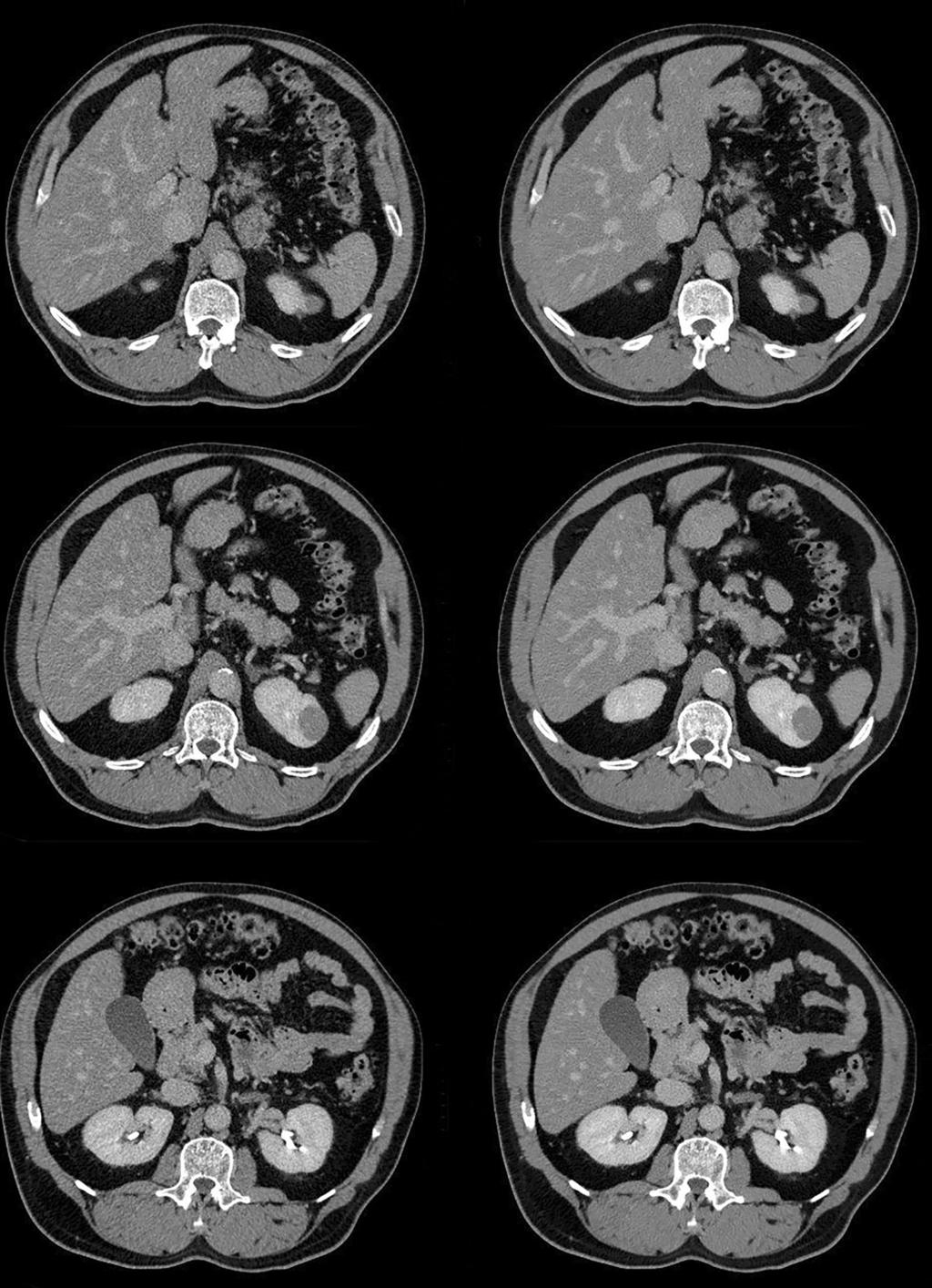 Fig. 4. Axial CT images of the abdomen obtained in an 87-year-old man.