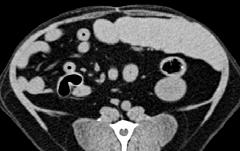Contrast medium can be used with CT to look for BBB
