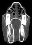 cavity MRN 122724 Fistula How Does CT Work?