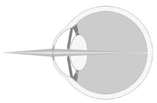 These disc shaped corneal implants work by changing the refractive index of the cornea. The central zone of the implant is neutral or plano, and has no refractive power.