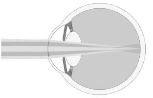 The central neutral zone is surrounded by one circular zone of additional positive power, which focus light rays from near objects on the retina, and improve near vision.