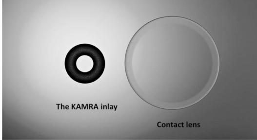 inlays are opaque, ring shaped with a central aperture.
