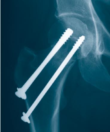 Indications 7.0 mm Cannulated Screws For fracture fixation of large bones and large bone fragments.