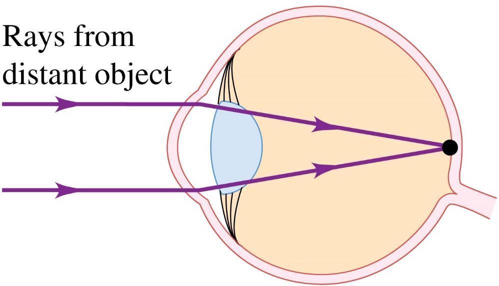 Defects of vision A normal eye forms an image on the retina of an object at infinity