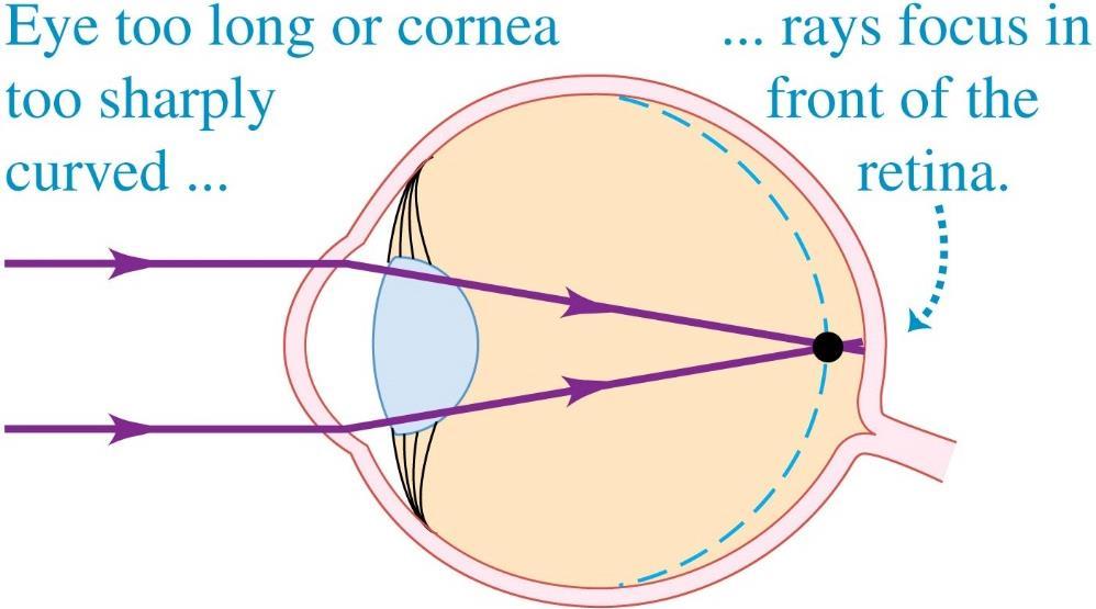 In the myopic (nearsighted) eye, the eyeball is too long from front to back in