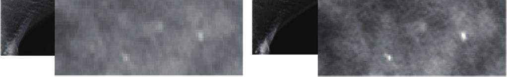 The figure indicates that with the proposed approach, the contrast is clearer and the visibility for microstructures such as calcification is better than the conventional approach.
