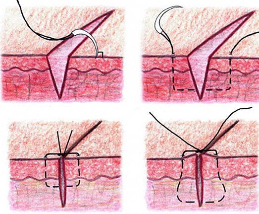 Suturing technique simple interrupted sutures Take bites equidistant from edge Needle