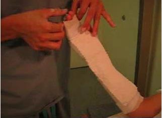 Volar Splinting with Plaster Apply the wet plaster to the volar