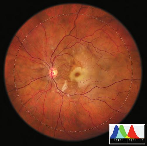Digitl Color Fundus Imge Qulity: the Impct of Tonl Resolution 19 Figure 8: Ophthlmic Photogrphers Society Best of Show Awrd Winner, 2006.