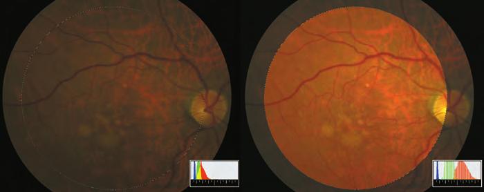 Figure 9: () The originl of very drk (under-exposed) digitl color retinl imge. Unfortuntely, the detil is so poorly documented tht the oserver could only guess which disese this eye hs.