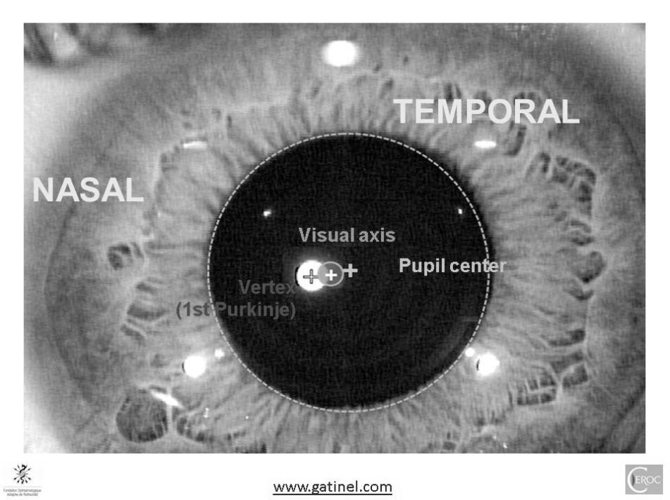 TROUBLESHOOTING: SOFT MULTIFOCALS Multifocal Contact Lenses Lower the add power and add plus to sphere power to decrease aberrations Revisit patient goals - get what they need most!