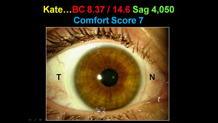 00 D corneal toricity Visible Iris Diameter 11.8mm +/- 0.