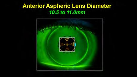 Ant. Aspheric Multifocal Powers Pupil Diameter Add Power 3.0mm 5.0mm +1.