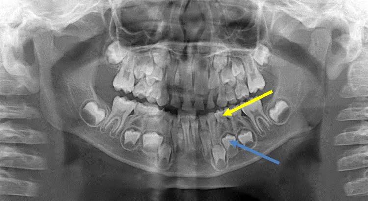 Figure 8: Dental x-ray of a seven year