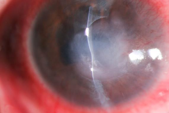 Erosion Optical Sectioning Keratic Precipitates Optical Sectioning Palpebral Cyst Anterior Chamber Depth Van