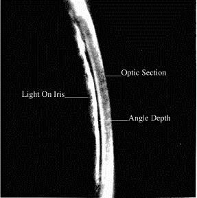 IRIS TO CORNEAL ANGULAR SEPARATION EQUALS 10 0 DEPTH (SHADOW) IS BETWEEN 1/4 AND 1/2 THE CORNEAL THICKNESS