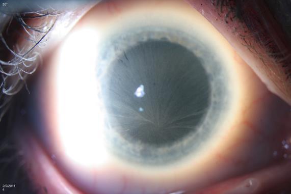 Sclerotic Scatter Vortex Keratopathy Retroillumination This