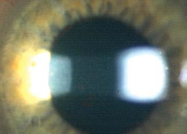 Optic section Optic section is a very thin parallelepiped and optically cuts a very thin slice of the cornea.