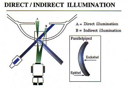 Indirect illumination Illumination: Narrow to medium slit beam