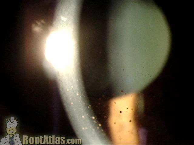 Retroillumination Formed by reflecting light of slit beam from a structure more posterior than the structure under observation. A vertical slit beam 1-4mm wide can be used.