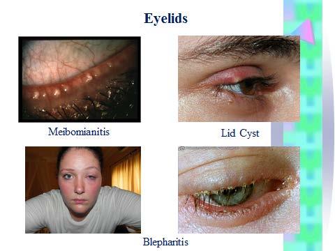 Anterior segment disease evaluation Lids and lashes Conjunctiva and cornea Instillation of