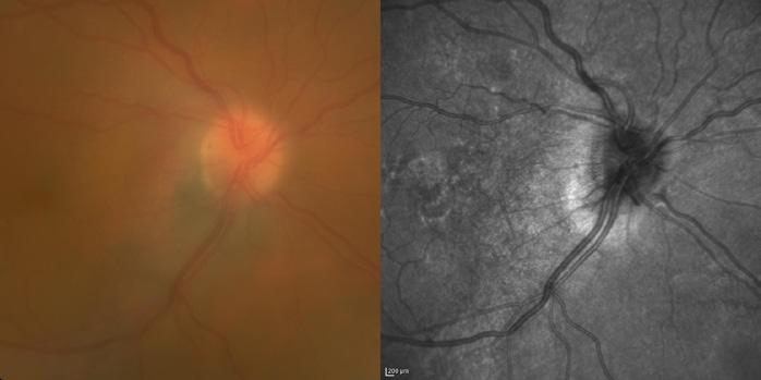 It can be used for several retinal imaging modalities including infrared reflectance (IR), blue reflectance, fluorescein angiography, ICG angiography and fundus autofluorescence (FAF).