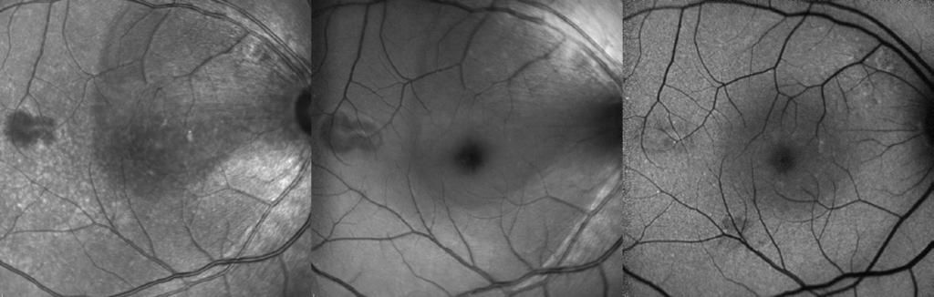 The Confocal Tonal Shift 19 Figure 4: A case of central serous chorioretinopathy with a classic serous detachment that