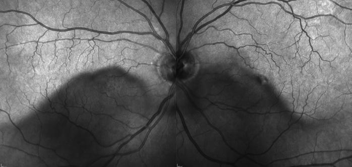 From left to right: IR, blue reflectance, fundus autofluorescence. The effect seems to be most pronounced in IR mode.
