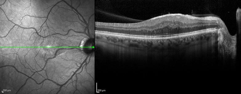 The confocal tonal shift can also affect the appearance of some anterior segment findings.