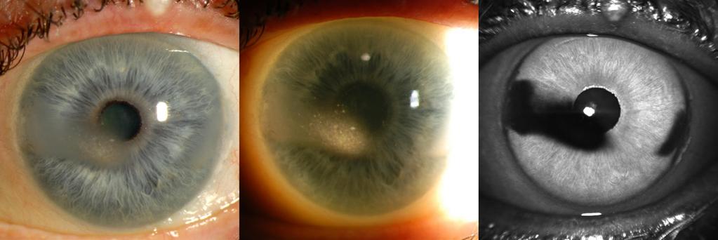 In addition to the confocal shift in focal planes, scattered light from some corneal lesions may also be suppressed by the pinhole, contributing to the dark appearance of the lesion (Figure 12).