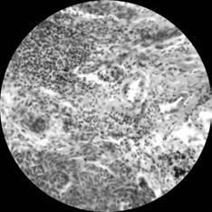 În melanom, în deosebi în zona de creştere a celulelor tumorale pe verticală, s-a constatat în 72,0±5,2%(p<0,001) infiltraţia limfoidă (foto 31). Foto 31.