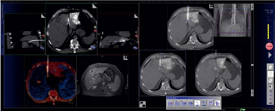 CT guided interventions Adaptive 3D Intervention Flexible fully customizable user interface.