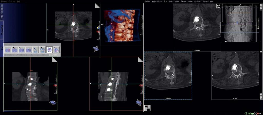 3D CT guided interventions Clinical