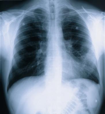 Thorax image with