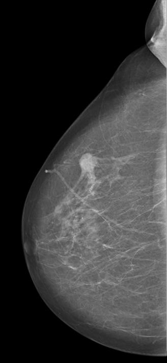 Screening & diagnostic mammography: High conspicuity of a tumor-suspicious