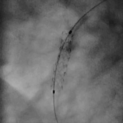 Visualization of stent struts 3 mm