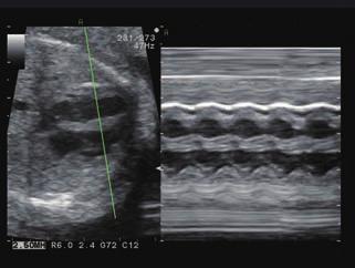 fast moving fetal heart, by displaying a real-time image and its slow-motion image together on