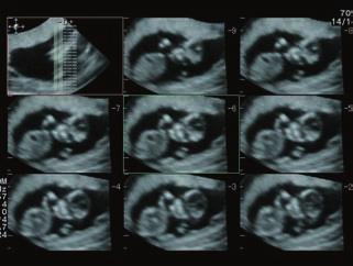For example, while a real-time image of two cardiac cycles is displayed, its slow-motion image