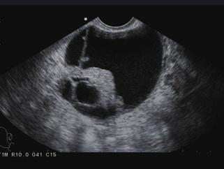 The fetal heart, valve leaflets, and regurgitation flows and other fast moving objects can be
