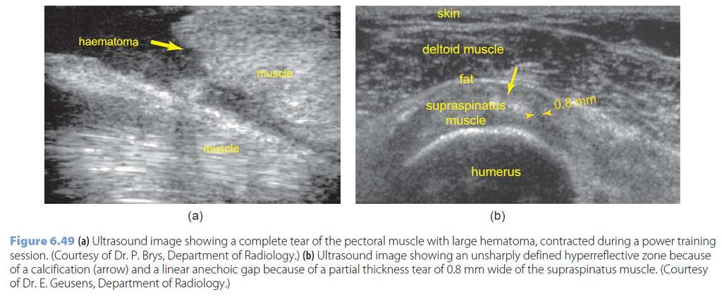 Musculoskeletal system Diagnosis of tears,