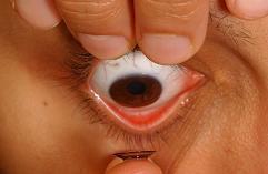 After insertion of the contact lenses, a few gentle blinks should make the lenses feel more comfortable.