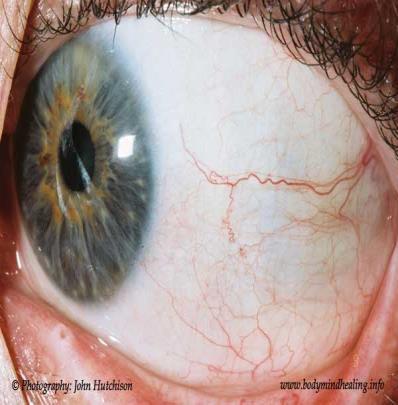 It fits into the surrounding white opaque tissue; the sclera like a watchglass and together they constitute the outer coat of the eye.