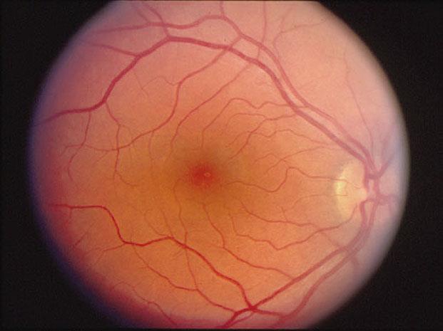 diseases). Fig 13: Fundus photograph showing the appearance of a normal retina. The retina performs the essential task of converting light to electrical impulses.