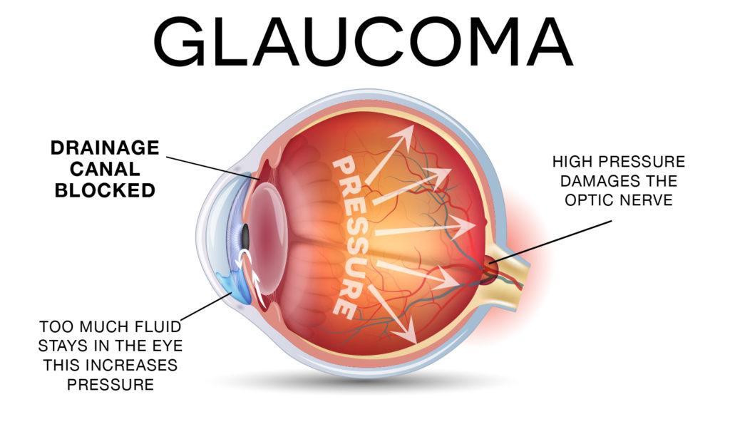 Homeostatic Imbalances: Glaucoma Macular Degeneration The treatments for Glaucoma and