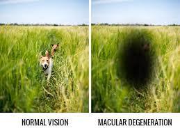 optic nerve Loss Center Field Vision Vision loss can keep decreasing until none is left