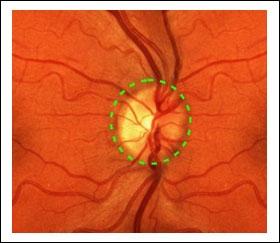 Optic disc is a circular area at the back of the eye where the optic nerve joins the retina.