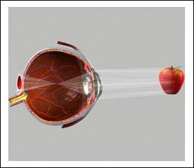 35) In conditions where the eyeball is too long, the focused image falls short of the retina, meaning the