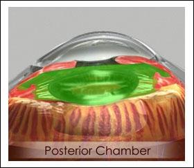 Unit 2: The anterior and posterior chambers are filled with aqueous humor, whereas the vitreous chamber is