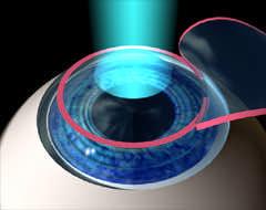 Photorefractive Keratectomy PRK, LASIK and Intacs Laser In-Situ Keratomileusis Intacs PRK uses a laser to remove corneal tissue